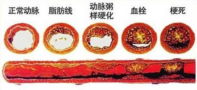 血栓在哪，病就在哪！該怎么清除血栓呢？